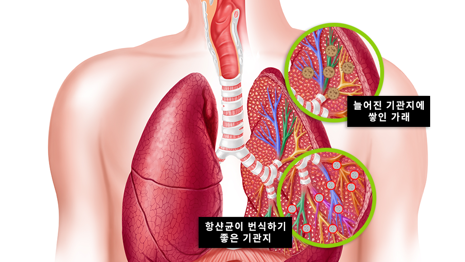 비결핵성항산균